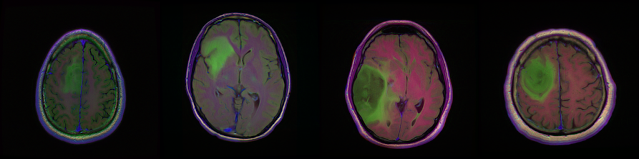Brain MRI Dataset